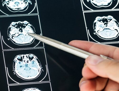 En qué consiste la resonancia magnética cerebral